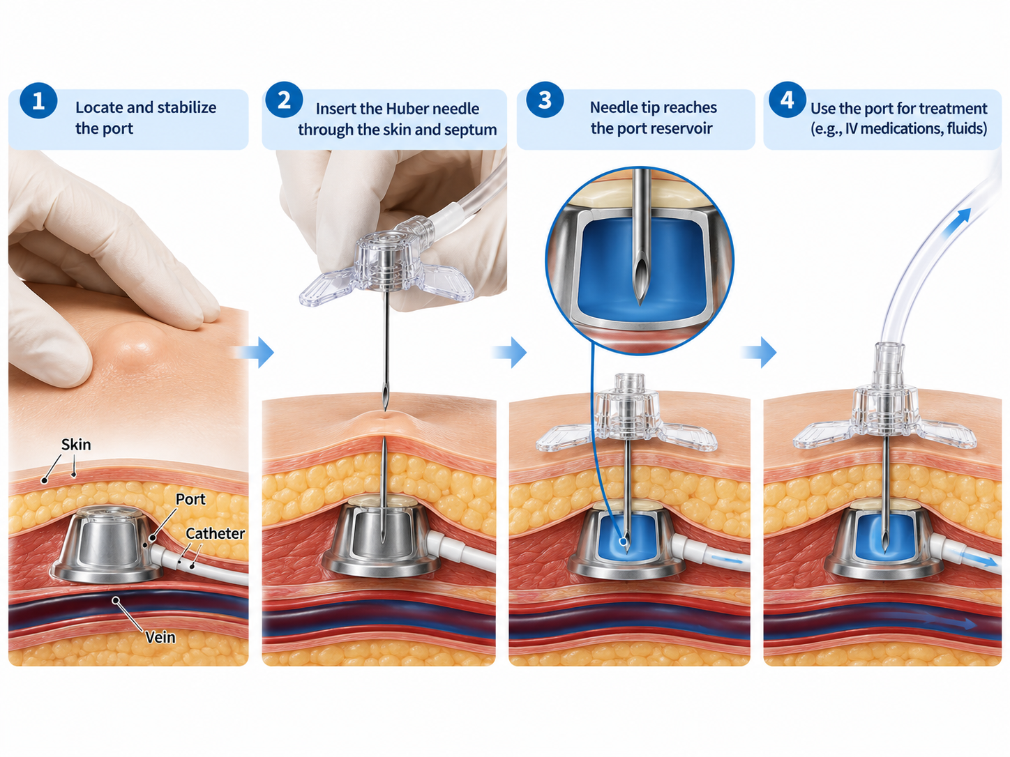 Huber Needle Access an Implanted Port