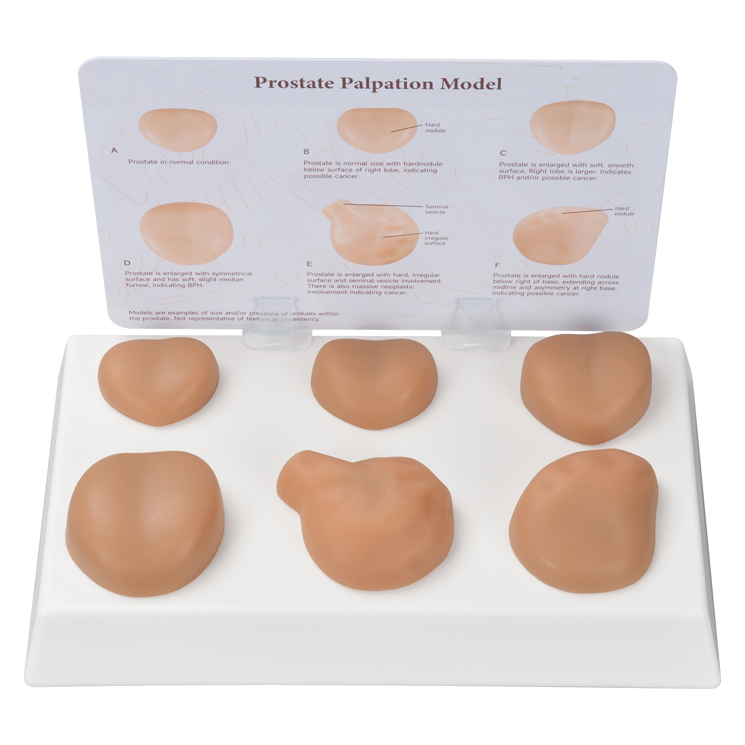 Prostate Palpation Simulator With 6 Pathology Stages