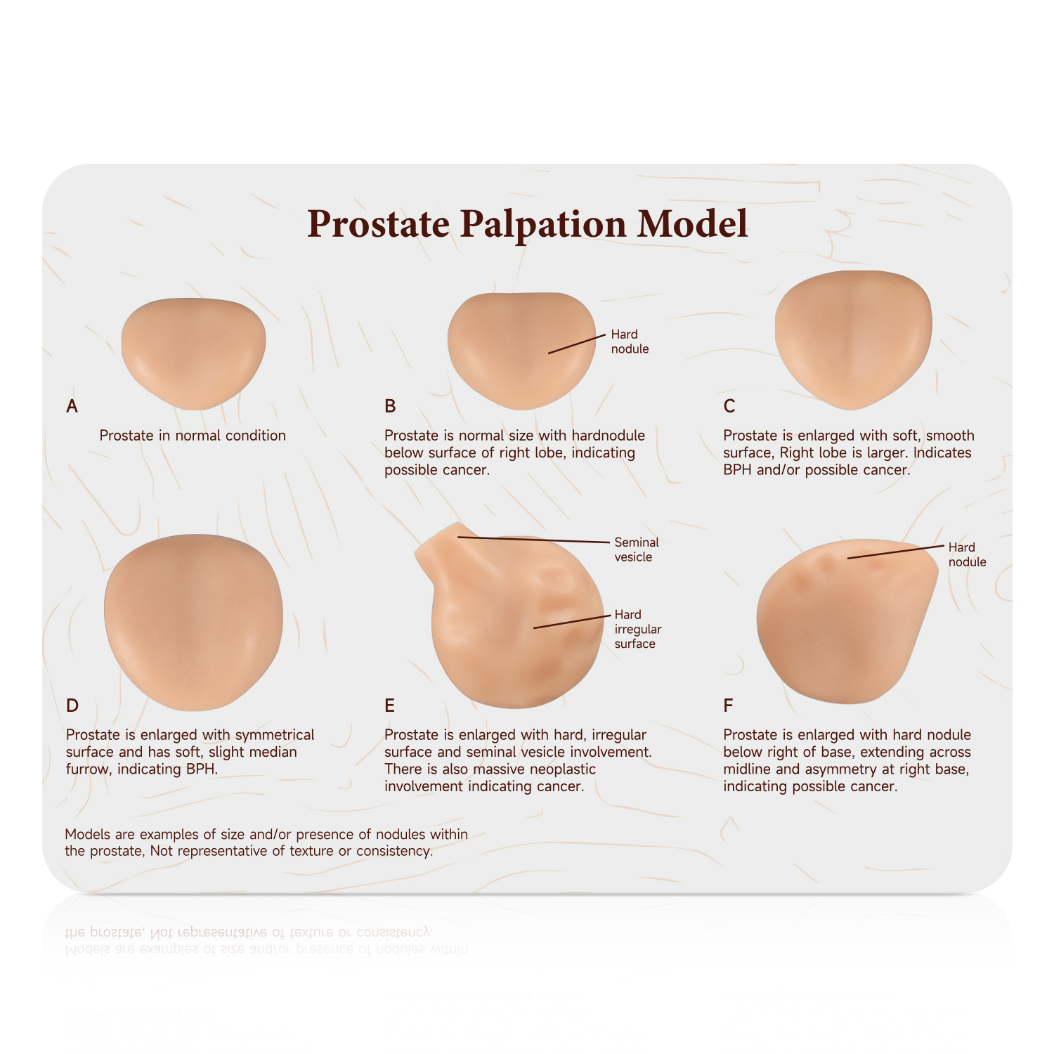 Prostate Pathology Reference Cards For Medical Students