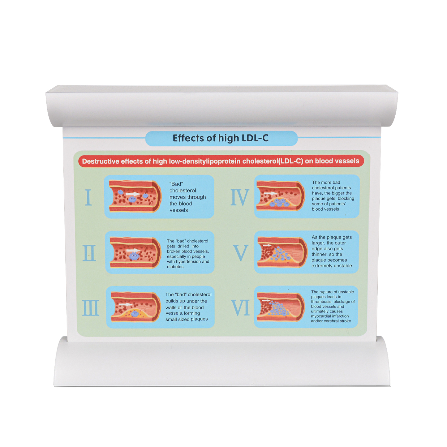 LDL Blood Vessel Model Showing Clear Stage Explanation