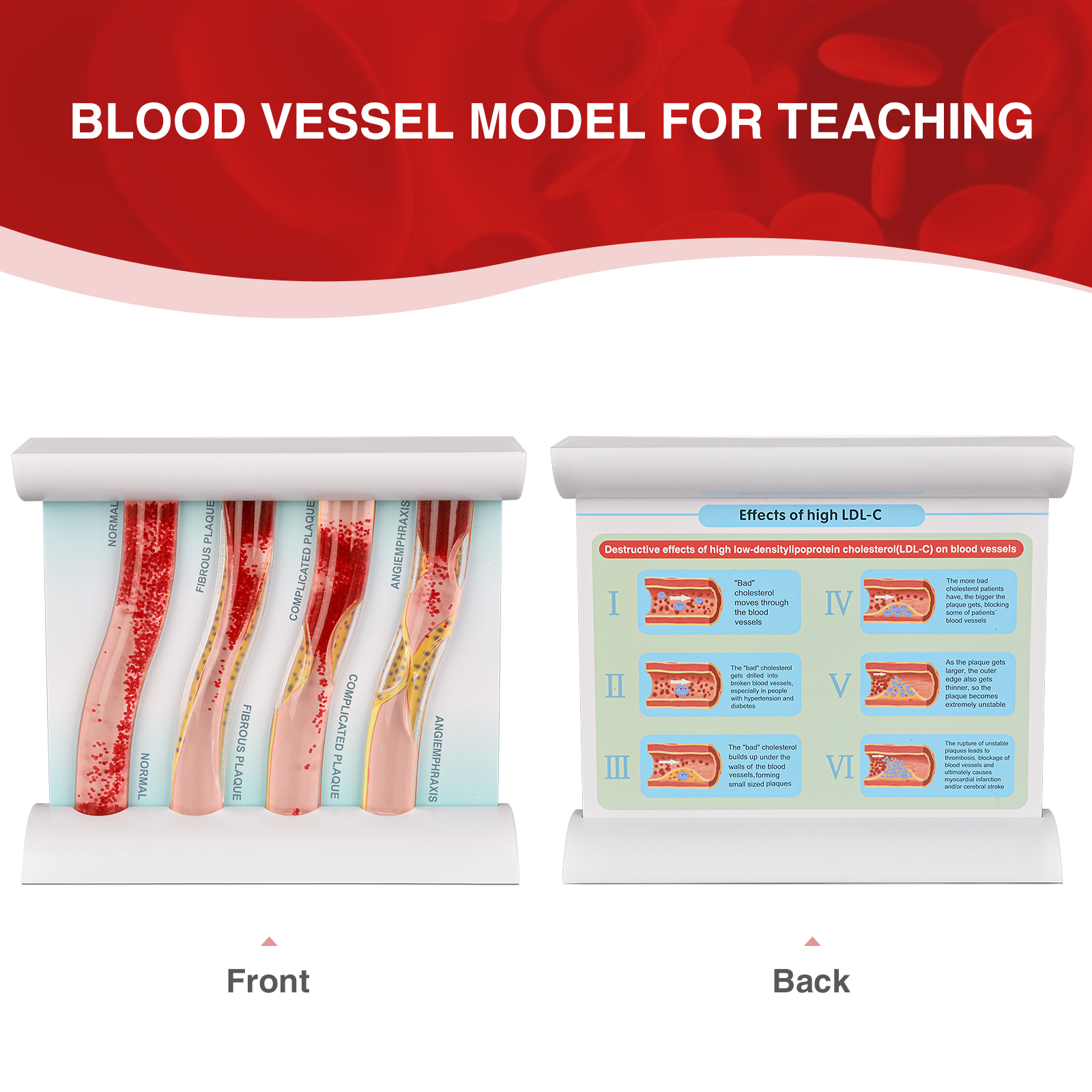The Front and Back View of LDL Blood Vessel Model