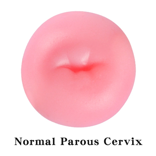 Normal Parous Cervix Image