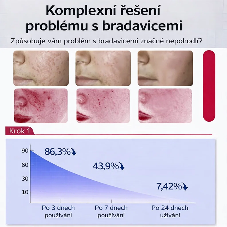 【Jednosekundový odstraňovač bradavic】Krém na odstranění bradavic