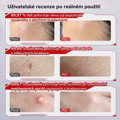 【Jednosekundový odstraňovač bradavic】Krém na odstranění bradavic