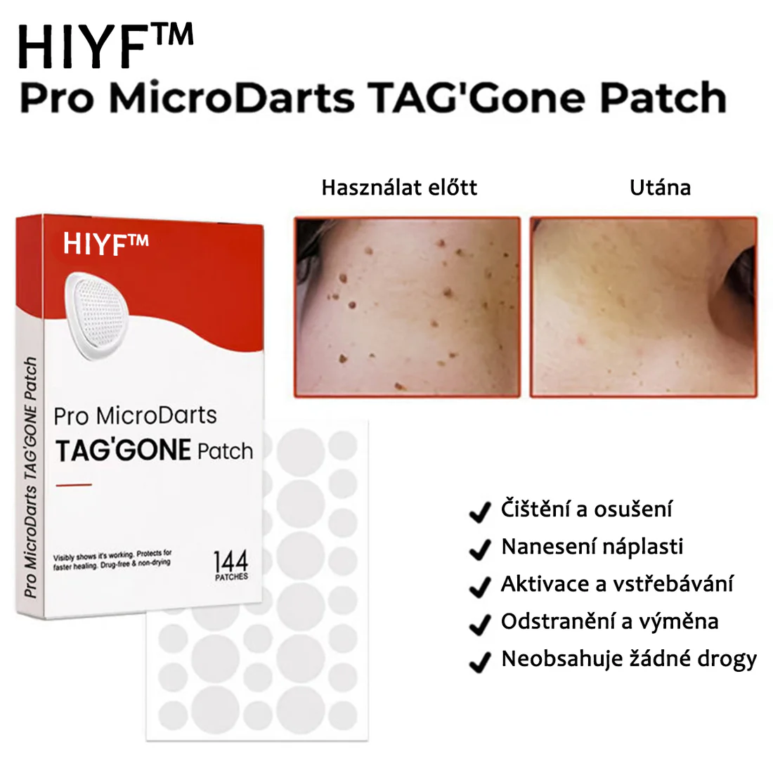 Náplasti na odstránenie kožných výrastkov KUBOZN® Pro MicroDarts TAG'Gone