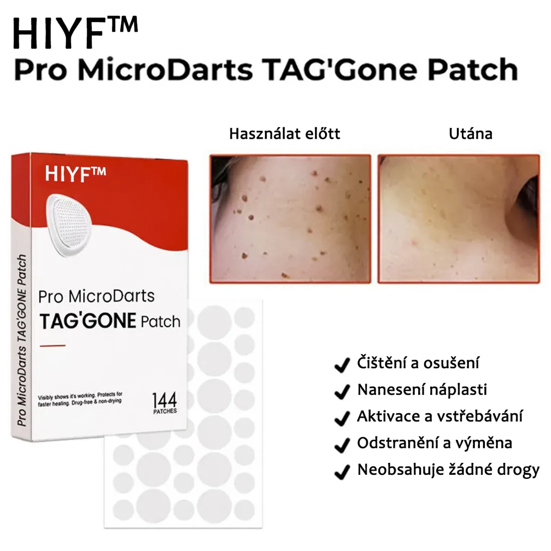 Náplasti na odstránenie kožných výrastkov KUBOZN® Pro MicroDarts TAG'Gone