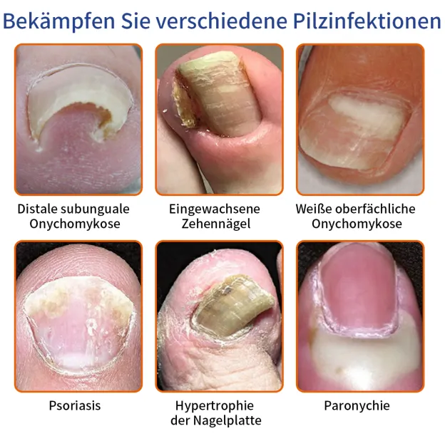 🌟🌟Furzero™ Řešení proti plísni nehtů včelím jedem: Kompletně řeší problém s plísní nehtů🐝🐝