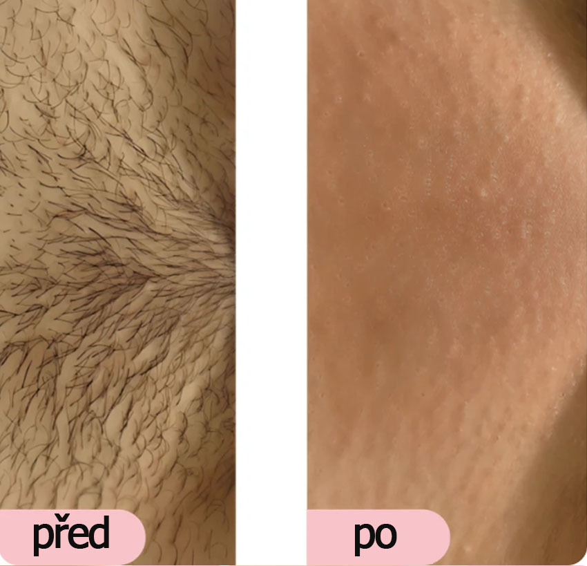 Glowie™ IPL fotoepilátor - Přístroj na odstraňování chloupků