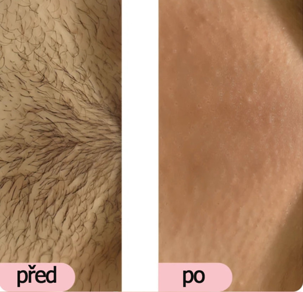 Glowie™ IPL fotoepilátor - Přístroj na odstraňování chloupků