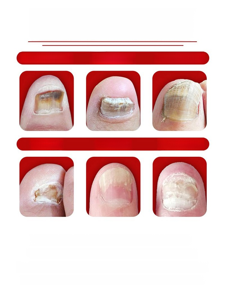 Introducing our all-natural plant-based nail care solution! Our formula addresses onychomycosis (fungal nail infection) at its root, promoting healthy nail growth.