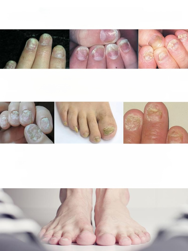 Introducing our all-natural plant-based nail care solution! Our formula addresses onychomycosis (fungal nail infection) at its root, promoting healthy nail growth.