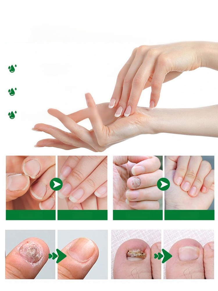 Introducing our all-natural plant-based nail care solution! Our formula addresses onychomycosis (fungal nail infection) at its root, promoting healthy nail growth.