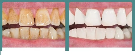 ULTRAHANGOS FOGÁSZATI MÉRLEG ERŐS VÍZKŐ ELTÁVOLÍTÁS