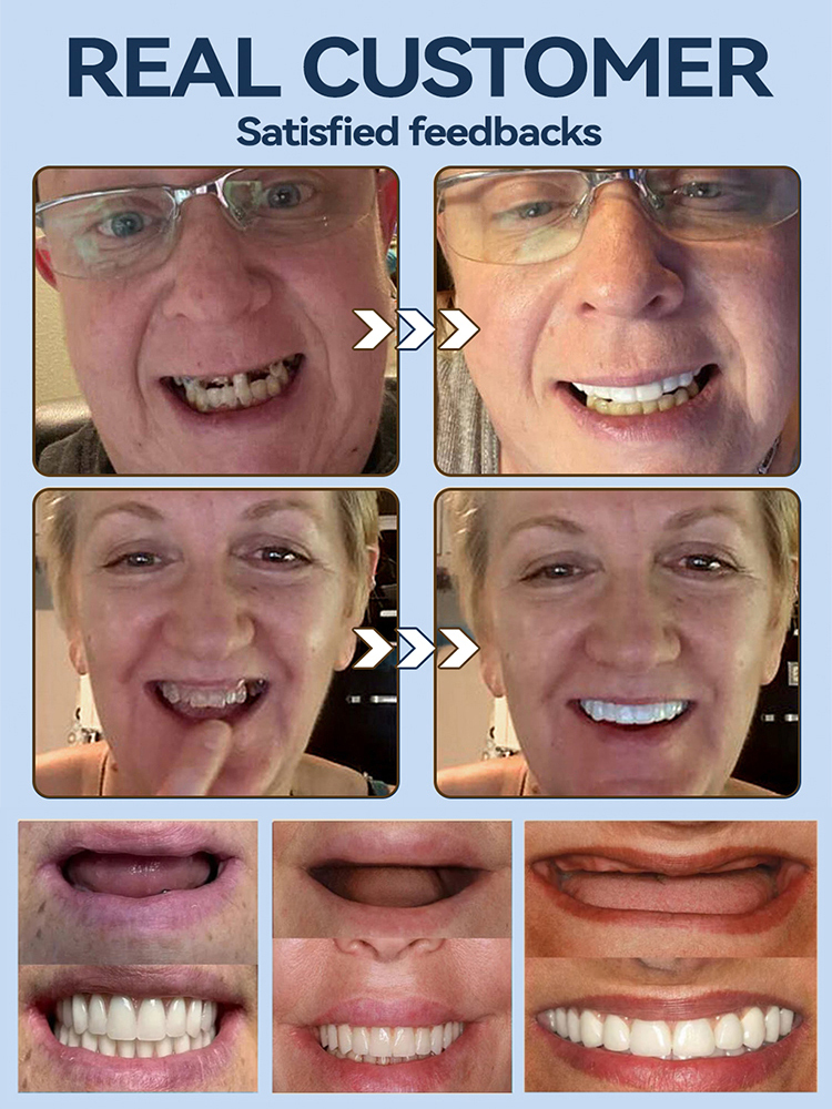 Imported simulation braces, dentists strongly recommend simulation correction braces