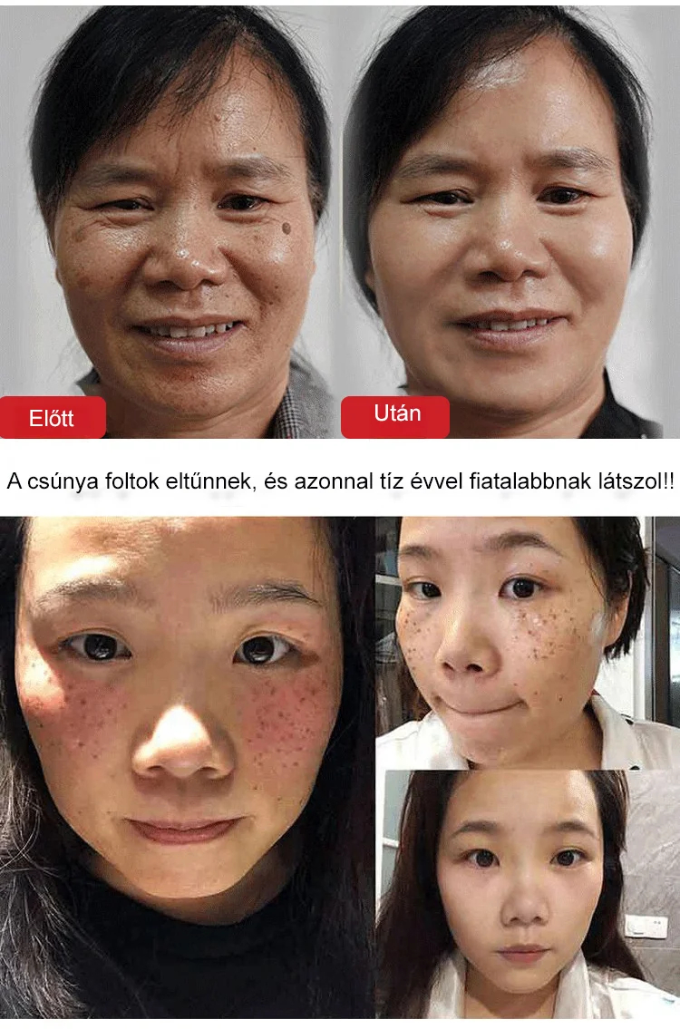 【Európában készült】Dr. Humei 377 Fehérítő és Pattanás elleni Krém