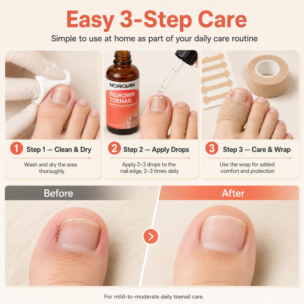 Morovan Ingrown Toenail Treatment,30ml Gentle Solution Kit for Men & Women, Toenail Care