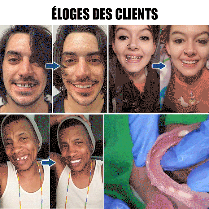Mieux que de vraies dents! Kit de restauration esthétique des dents prothétiques