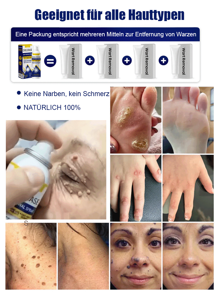 ✨Kryotherapie-Warzenentfernungsspray mit fortschrittlicher Kryotherapie-Technologie✅ Entfernt 99,9 % der Warzenwurzeln schmerzfrei, narbenfrei und reizt die Haut nicht.🍃 Mit beruhigenden Pflanzenextrakten, für alle Hauttypen geeignet.