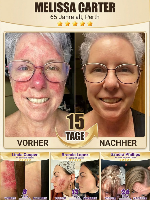 【In 2 Wochen alle Hautprobleme verabschieden】Biotin Hautreparaturcreme