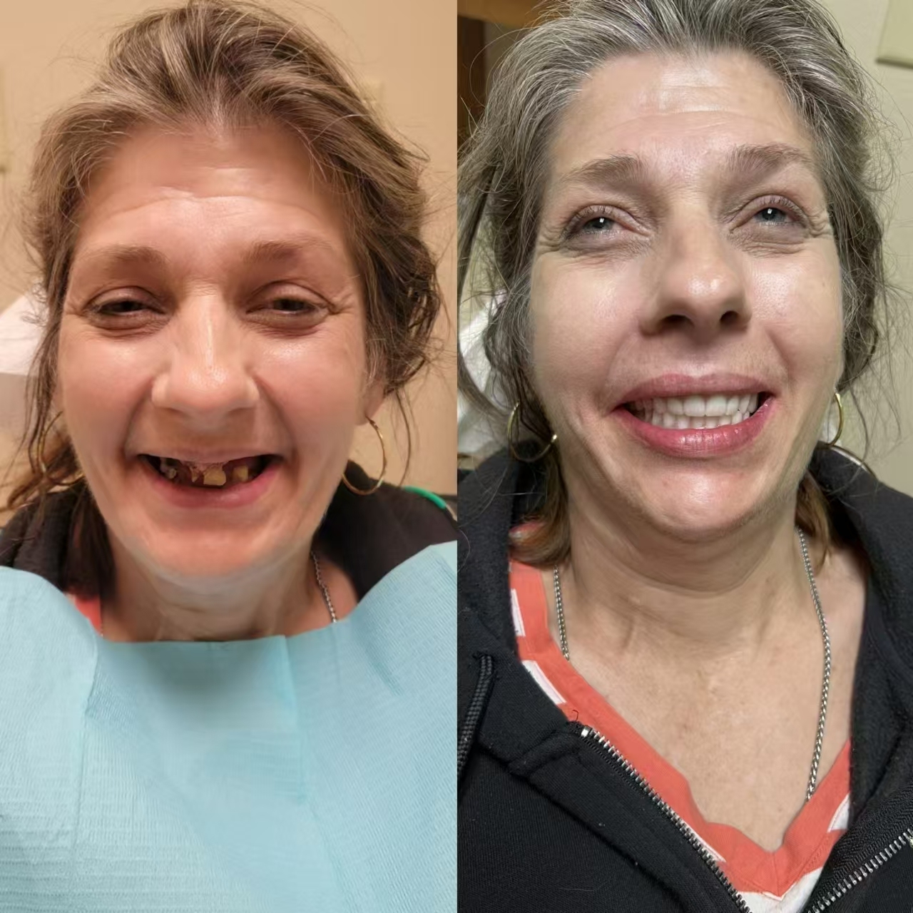 Easy Denture™ kerámia kompozit szilikon állítható univerzális fogpótlás