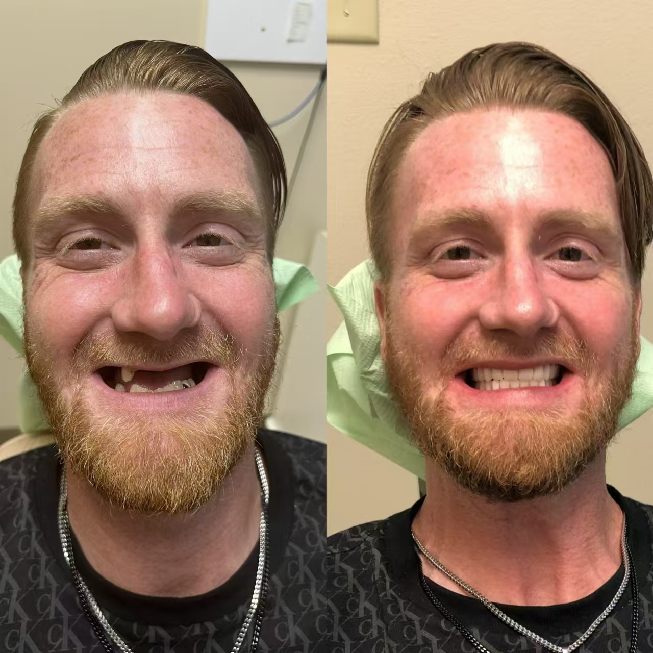 Easy Denture™ kerámia kompozit szilikon állítható univerzális fogpótlás