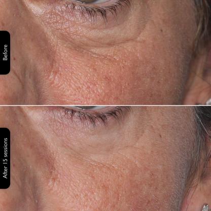 ** LED Face Mask – 4-in-1 Multi-Functional Skin Care Device**  