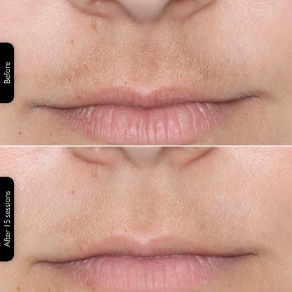 ** LED Face Mask – 4-in-1 Multi-Functional Skin Care Device**  