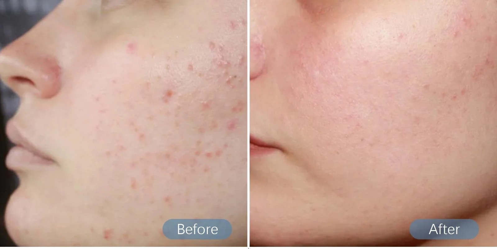 M8S DR Pen antes e depois