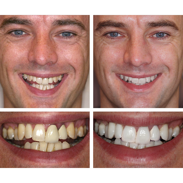 TEUVCTU™ Teeth Whitening Essence