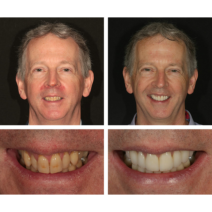 TEUVCTU™ Teeth Whitening Essence