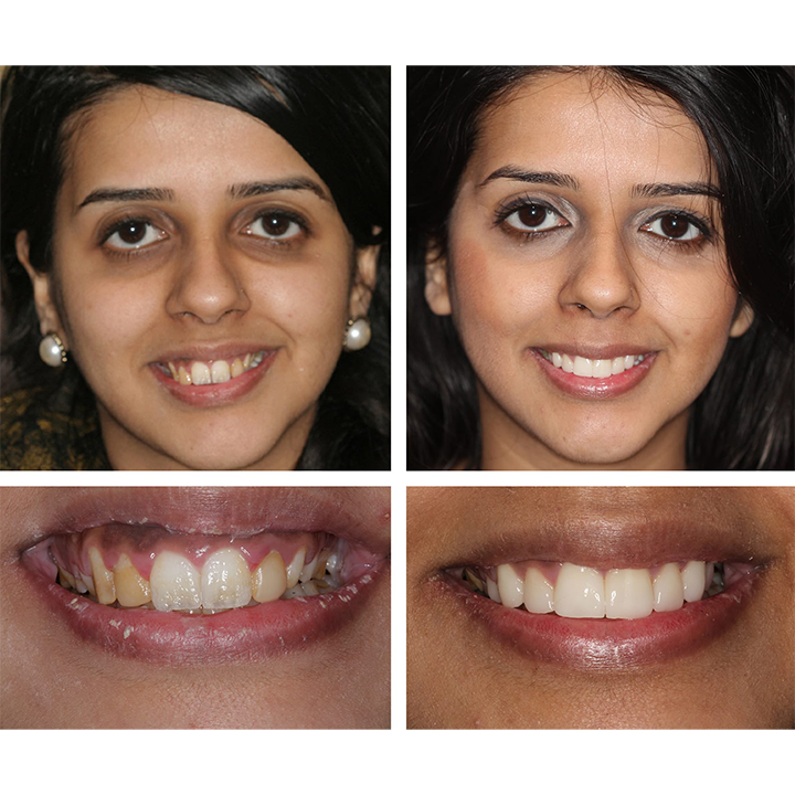 TEUVCTU™ Teeth Whitening Essence