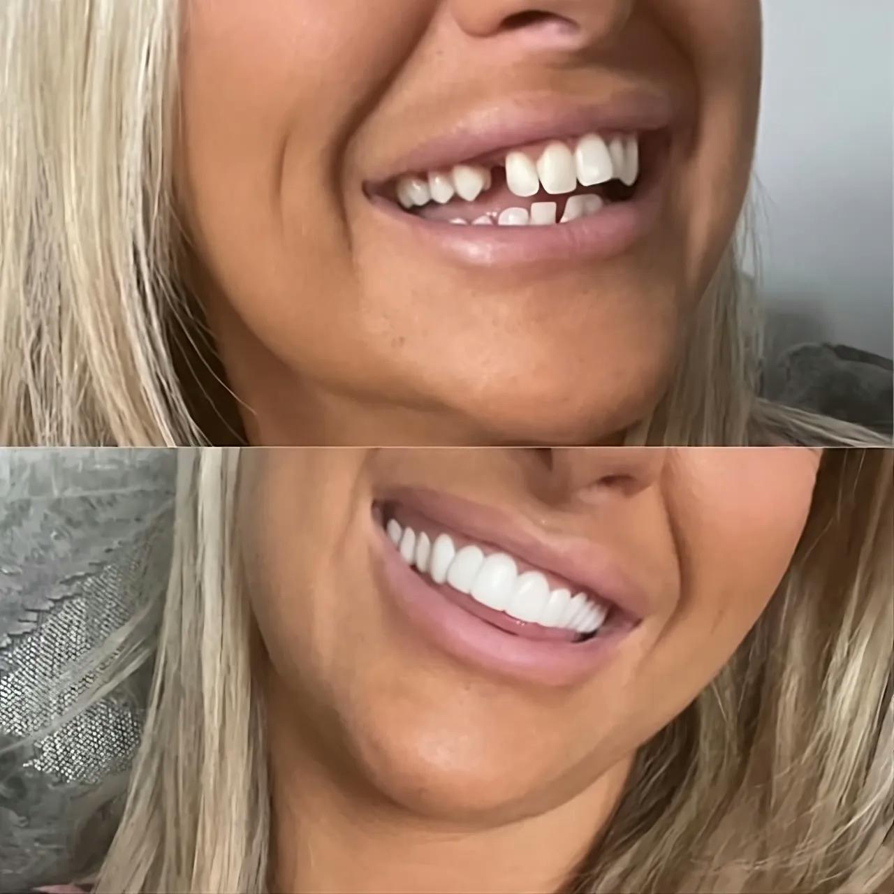 Veenora™ Clip-on Veneers