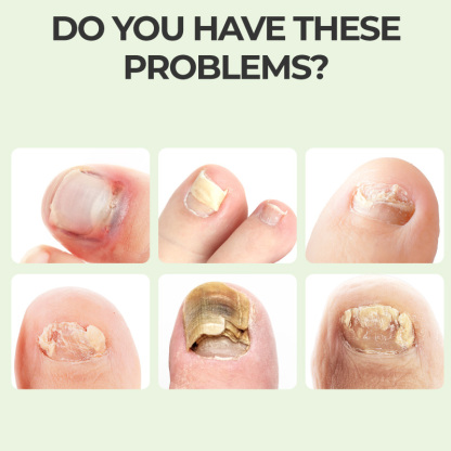 Kreain Nature™Tea Tree & Ginger Nail Treatment