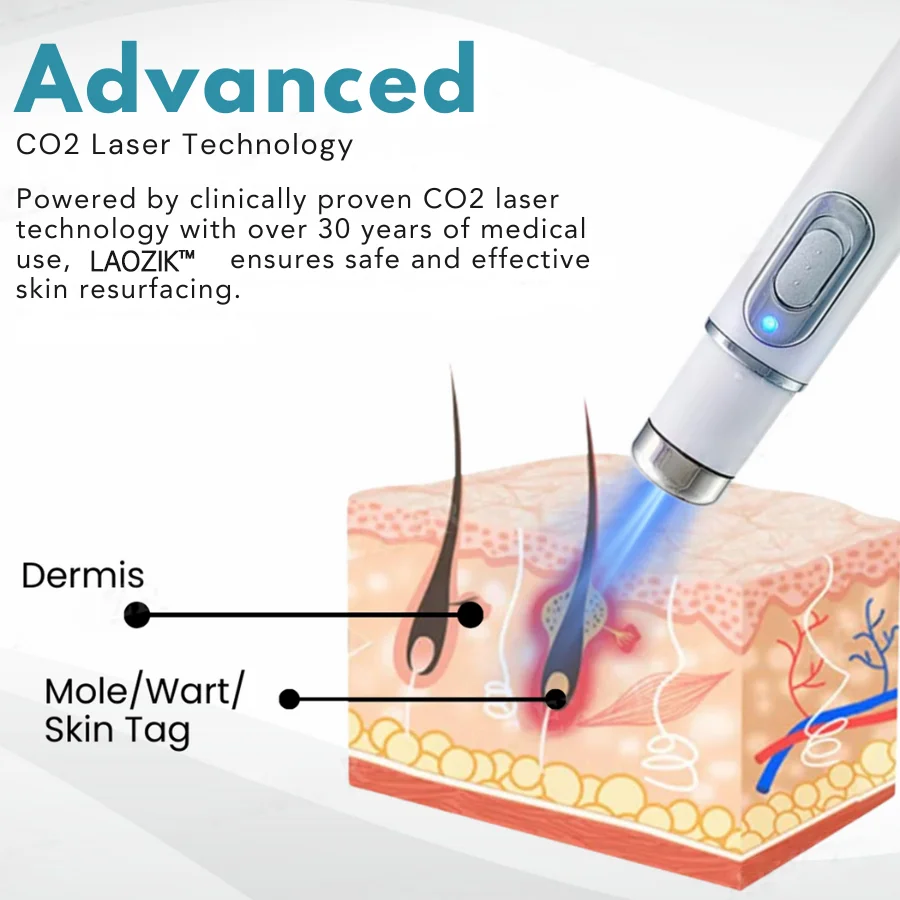  Non-Invasive Mole and Wart Removal Laser Pen