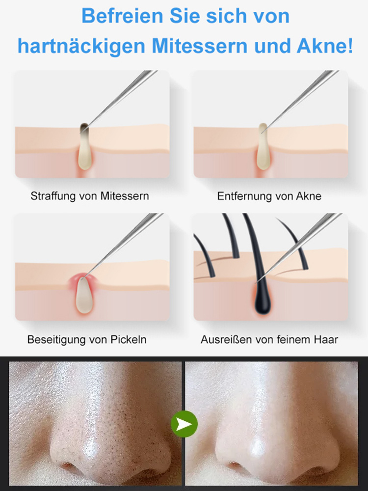 Profi Komedonenquetscher Set aus Chirurgenstahl | Charité-Standard Präzision | 0,01mm Ultra-Fein | Sanft & Narbenfrei ♀️✨