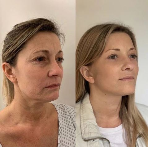 BOTOX STOCK SOLUTION ANTI-AGING SERUM