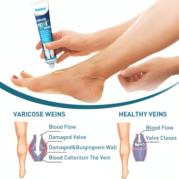 SUMIFUN VARICOSE VEINS CREAM