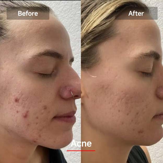 Veonskin LED Rött Ljus Ansiktsmask