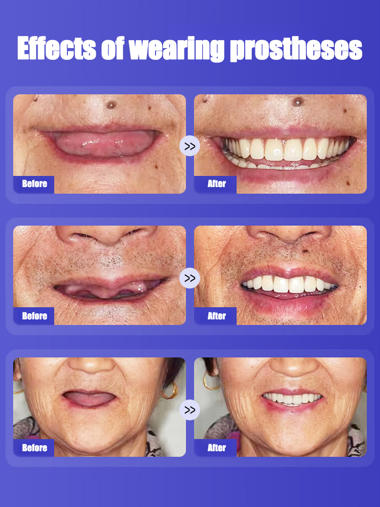 Enjoy apples again—No slipping, No worry! No Glue Needed! Confident Smile Silicone Denture Kit