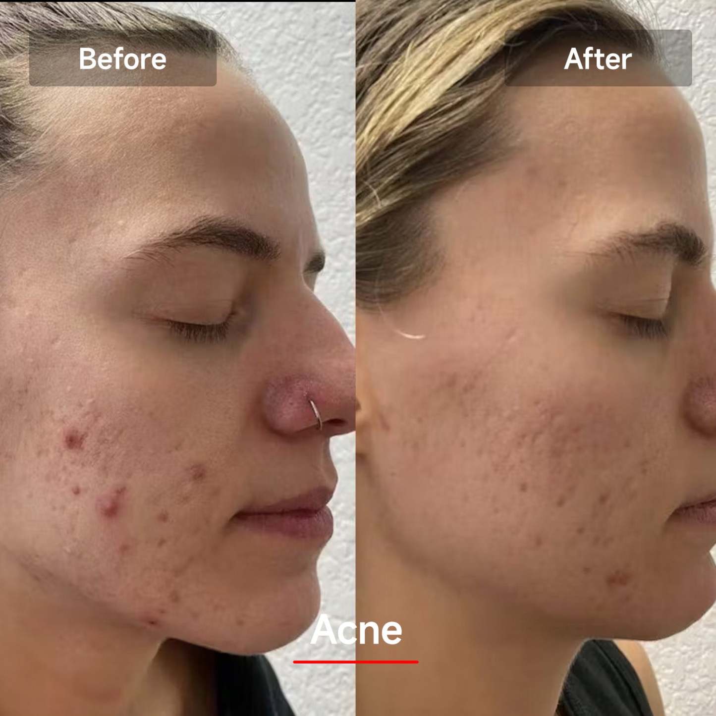 Veonskin LED Rött Ljus Ansiktsmask