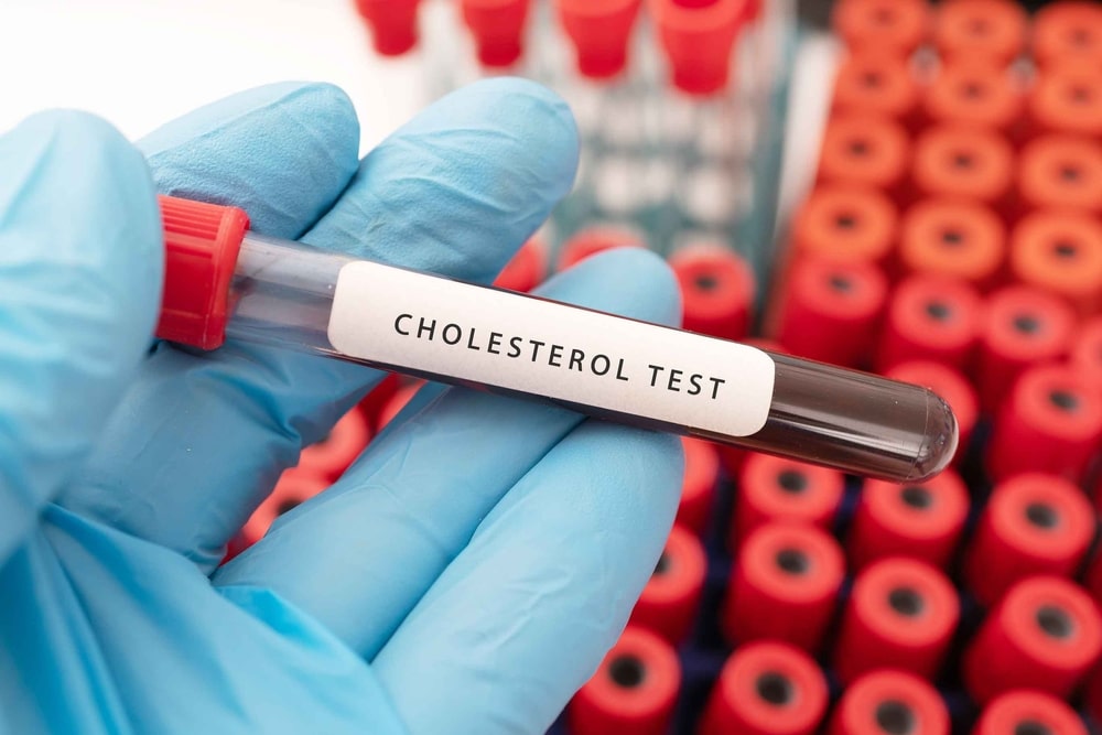 Cholesterol-Blood-Tests-Do-we-need-to-get-them-regularly.jpg