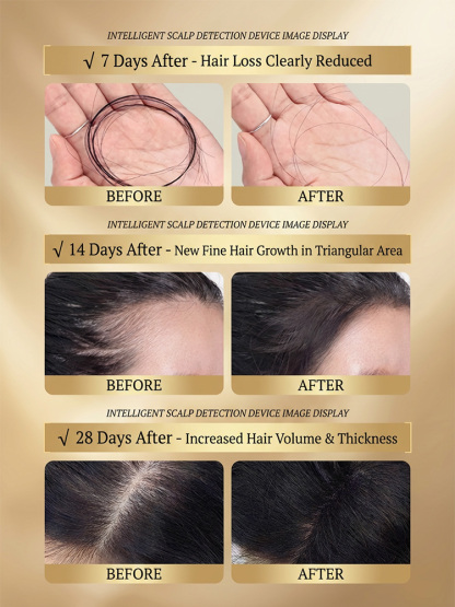 [Double Hair Volume] Anti-Hair Loss Shampoo【Personally tested and effective】