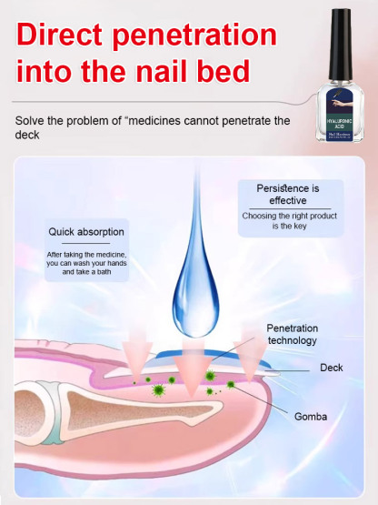 Antifungal nail repair solution