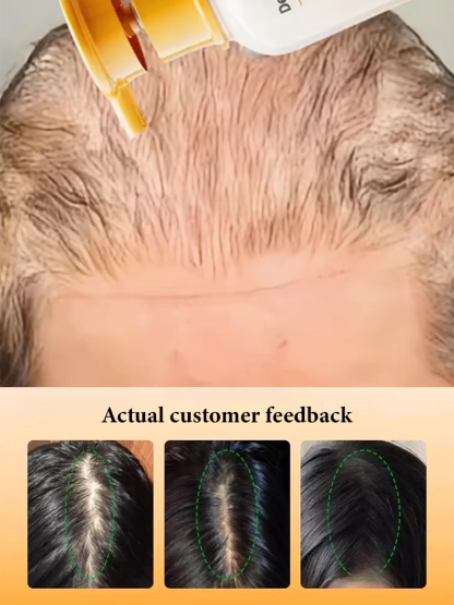 [Double Hair Volume] Anti-Hair Loss Shampoo【Personally tested and effective】