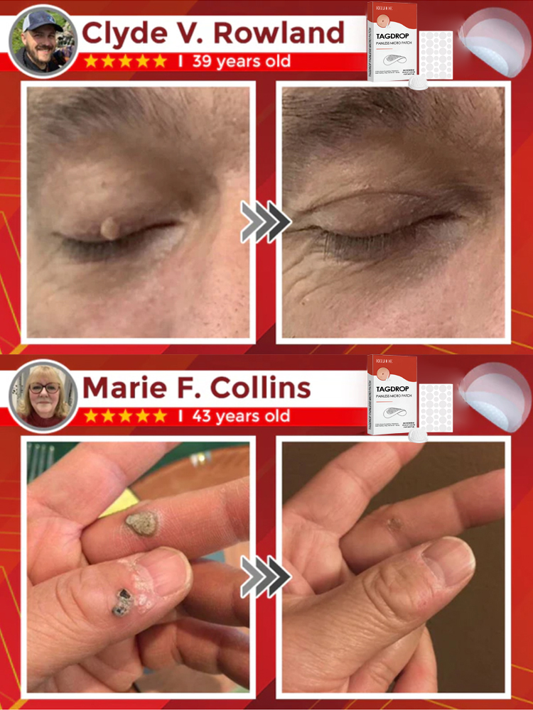 [Scar-Free] Painless Acne Patches【Buy 1 free 1】