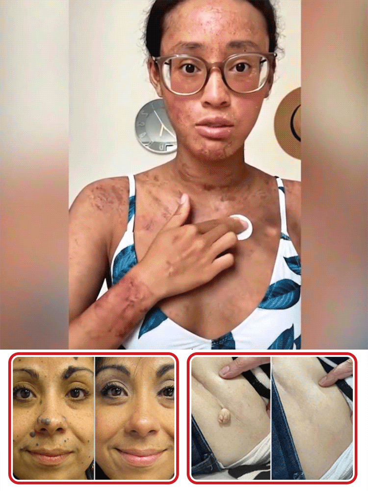 [Scar-Free] Painless Acne Patches【Buy 1 free 1】