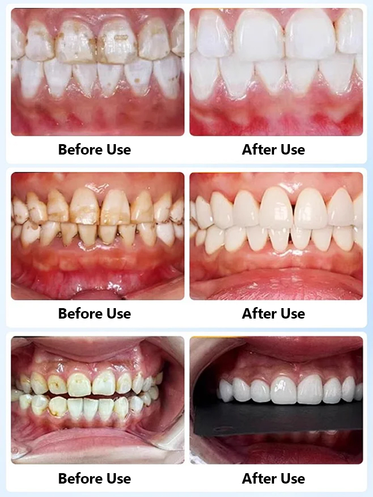 [Recommended by Dentists] Powerful Home Ultrasonic Tooth Cleaner