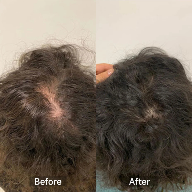 VeonSkin GrowMax – Laser‑ und LED‑Kappe für Haarregeneration