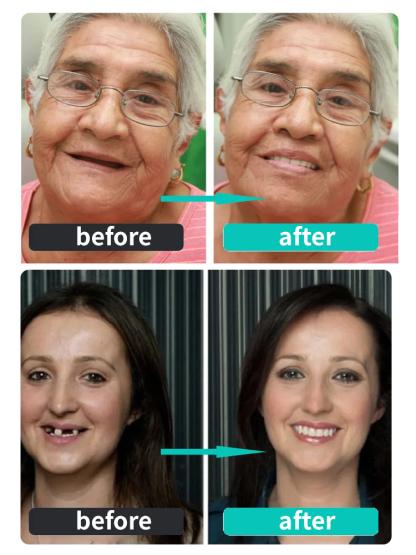 🦷The Smile Booster – Silicone Dentures – Will Instantly Make You Speak with More Confidence