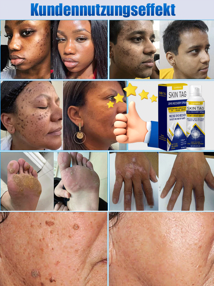 LANISKA Warzenpflege-Spray zur äußerlichen Anwendung